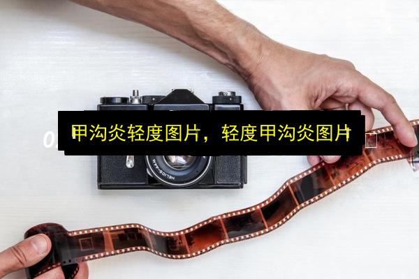 甲沟炎轻度图片,轻度甲沟炎图片插图 文章配图